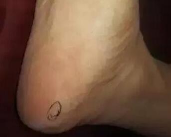 坐骨神经疼绝招.jpg